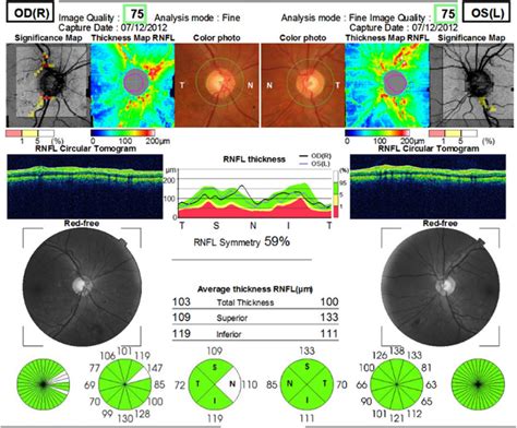 Typical Optical Coherence Tomography Oct Report Patient Number A Download Scientific