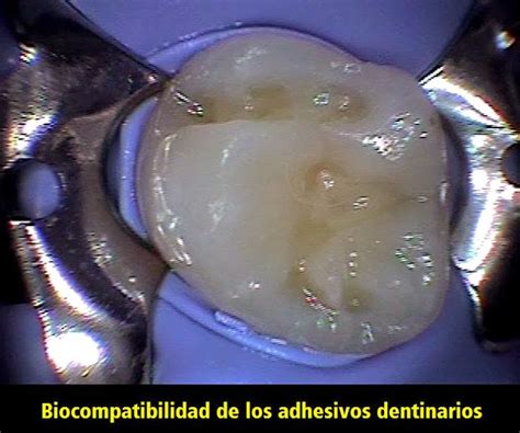 Pdf Biocompatibilidad De Los Adhesivos Dentinarios Ovi Dental