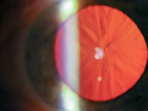Dilated Eye Exams Explained Kindsight Eye Specialists