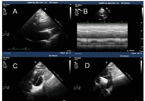 Transthoracic Echocardiography In Parasternal Long Axis View A M