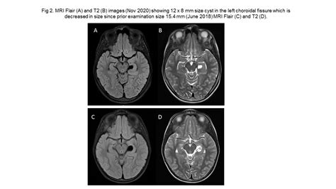Novel Gene Abnormality In Epilepsy With Myoclonic Astatic Seizures