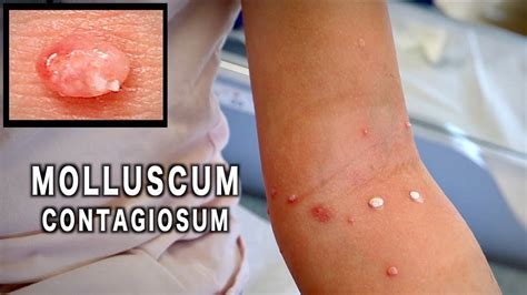 Molluscum Contagiosum Causes And Treatment Dermnet Vrogue Co