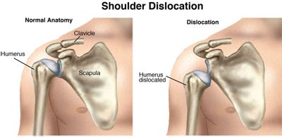 Shoulder pain can greatly hamper any training routine and tends to require long periods of time for complete recuperation. Dislocated Shoulder | New Health Guide