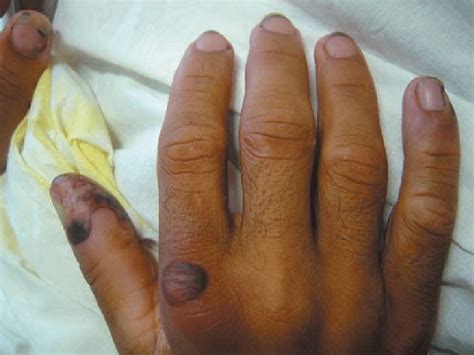 Hemorrhagic Lesions And Purulent Purpura On The Right Hand Download