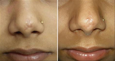 Microneedling Surgical Scars Areton Limited