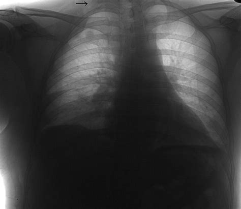 First Rib Resection In Thoracic Outlet Syndrome Journal Of Hand Surgery