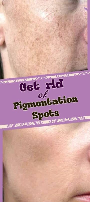 Get Rid Of Pigmentation Spots Dark Spots Women World Remedies