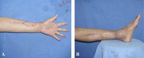 Posterior Tibial Artery Flap Versus Radial Forearm Flap In Oral Cavity