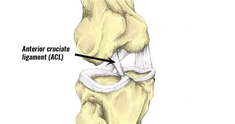 Acl Sprain Anterior Cruciate Ligament Diagnosis And Treatment