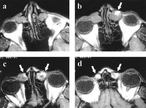 Mr Dacryocystography Comparison With Dacryocystography And Ct