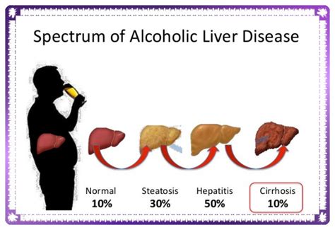 Alcoholic Liver Disease Sure Developers Team
