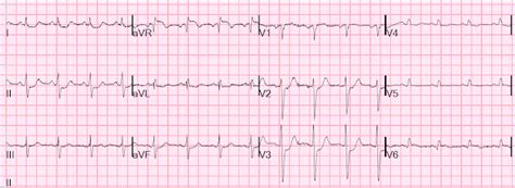 Dr Smiths Ecg Blog Guess The Culprit With St Elevation In Posterior