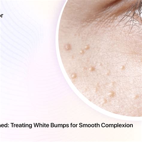 Milia Skin Explained Treating White Bumps For Smooth Complexion