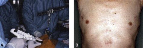 Video Assisted Thoracoscopic Bilateral Lung Metastasectomy With A