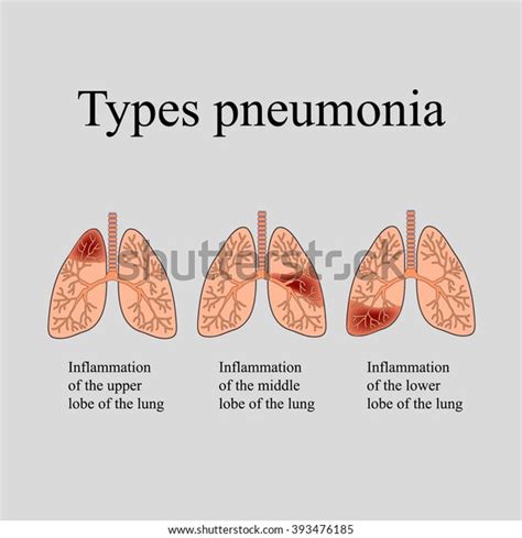 Pneumonia Anatomical Structure Human Lung Type Lagervektor