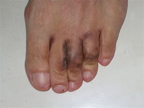 Blackish Discoloured Skin Of Toes And Toe Webs With Scaling Download