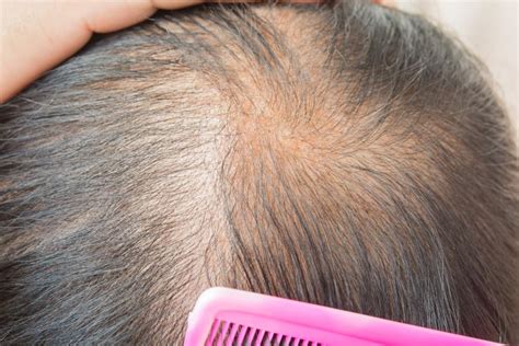 Thinning Hair Causes Types Treatment And Remedies