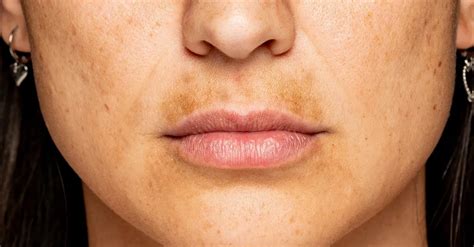 Hyperpigmentation Around The Mouth Causes Treatment And Prevention
