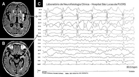 Periodic Lateralized Epileptiform Discharges Pleds In Herpetic