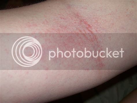 Small Red Rash On Inside Of Elbows Mylesrichards1s Blog
