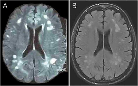 Cerebral Edema Brain Ct