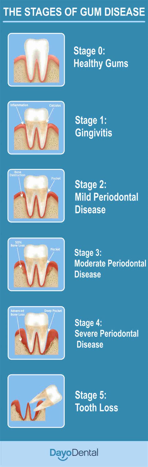 Periodontal Disease Stages