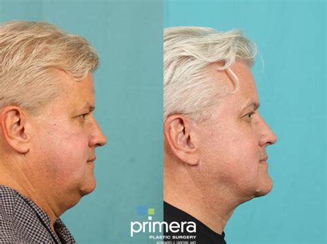 Mini Facelift Before And After Pictures Case 773 Orlando Florida Primera Plastic Surgery