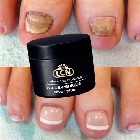 The Wonders Of Using Wilde Pedique By LCN For Toenail Reconstruction Forme Di Unghie