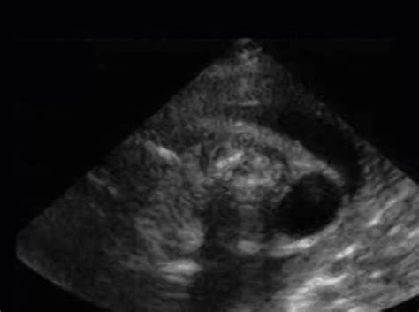 Branchial Cleft Cyst Ultrasoundpaedia