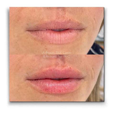 Temporary Lip Fillers Get Fuller Lips La Beauty Skin Center