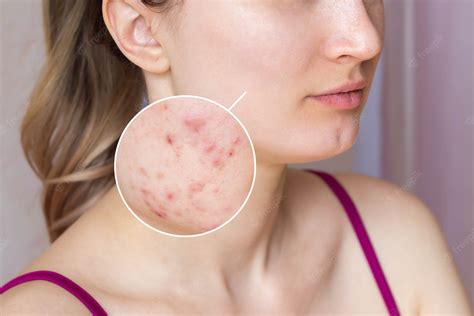 Premium Photo Cropped Shot Of Young Womans Face With Acne Skin In