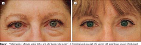 Pdf Orbicularis Suspension Flap And Its Effect On Lower Eyelid