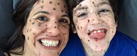 Moms Message To Strangers Laughing At Her Sons Birthmarks Popsugar