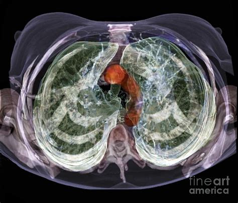 Healthy Lungs 3d Ct Scan Photograph By Zephyr Pixels