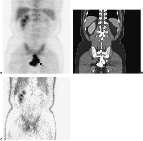Artifacts And Normal Variants In Fdg Pet Radiology Key