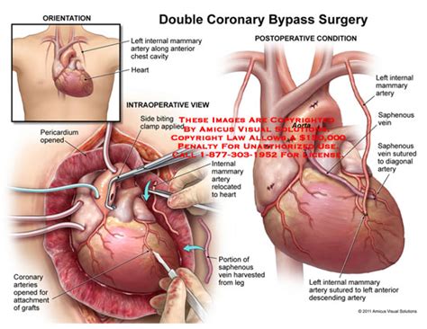 Double Coronary Bypass Surgery
