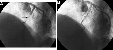 Myotomy After Previous Coronary Artery Bypass Grafting For Treatment Of