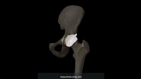 Orthopedic Surgery Videos George Gendy Md