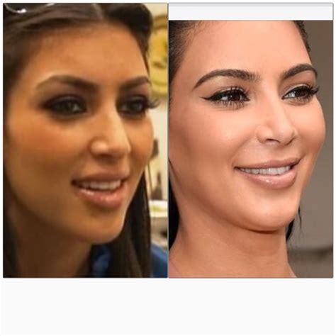 Kim Kardashian Nose Job Kim Kardashian Surgery Kim Kardashian Before Aesthetic Dermatology