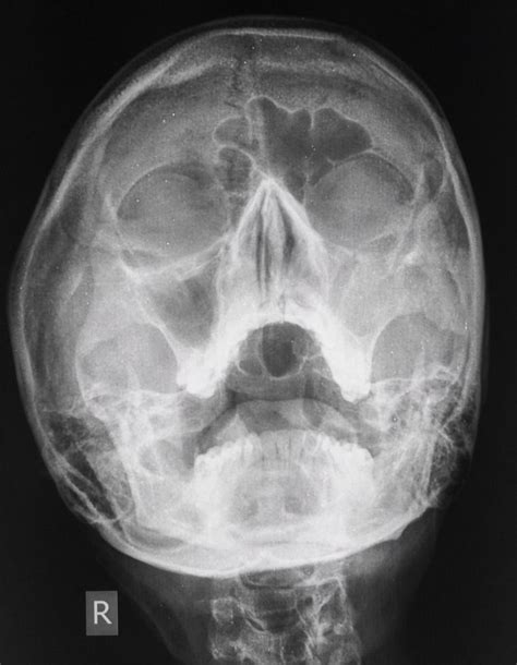 Maxillary Sinusitis Radiology Case Radiopaedia Org Radiology