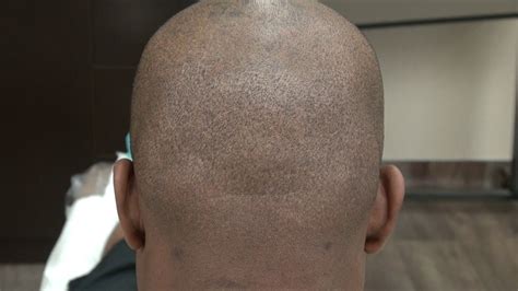 Scar Fue Hair Transplant Surgery Donor Follicular Unit Extraction Dr