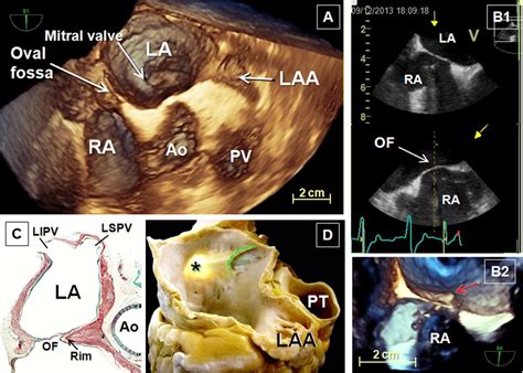 Left Atrial Appendage Anatomy And Imaging Landmarks Pertinent To