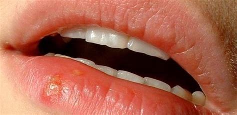 Cold Sores Symptoms Causes Measures And Treatment Earths Lab