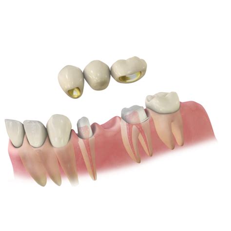 Zahnkrone Es wird verwendet um fehlende Zähne zu ersetzen Optik und