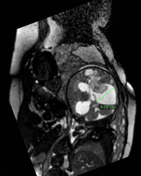 Germinal Matrix Hemorrhage Causes Symptoms Diagnosis Treatment