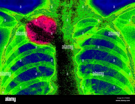 Ewings Sarcoma X Ray Stock Photo Alamy
