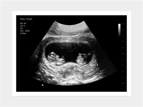 8 Week Ultrasound Photo