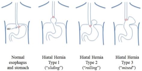 Hiatal Hernia The Operative Review Of Surgery