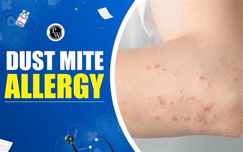 Dust Mite Allergy Symptoms Complications And Treatment