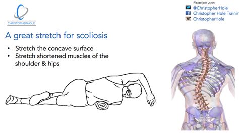 Scoliosis The Basics Of An Exercise Program Bút Chì Xanh